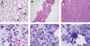 Myelodysplastic Syndrome With Excess Blasts And Fibrosis