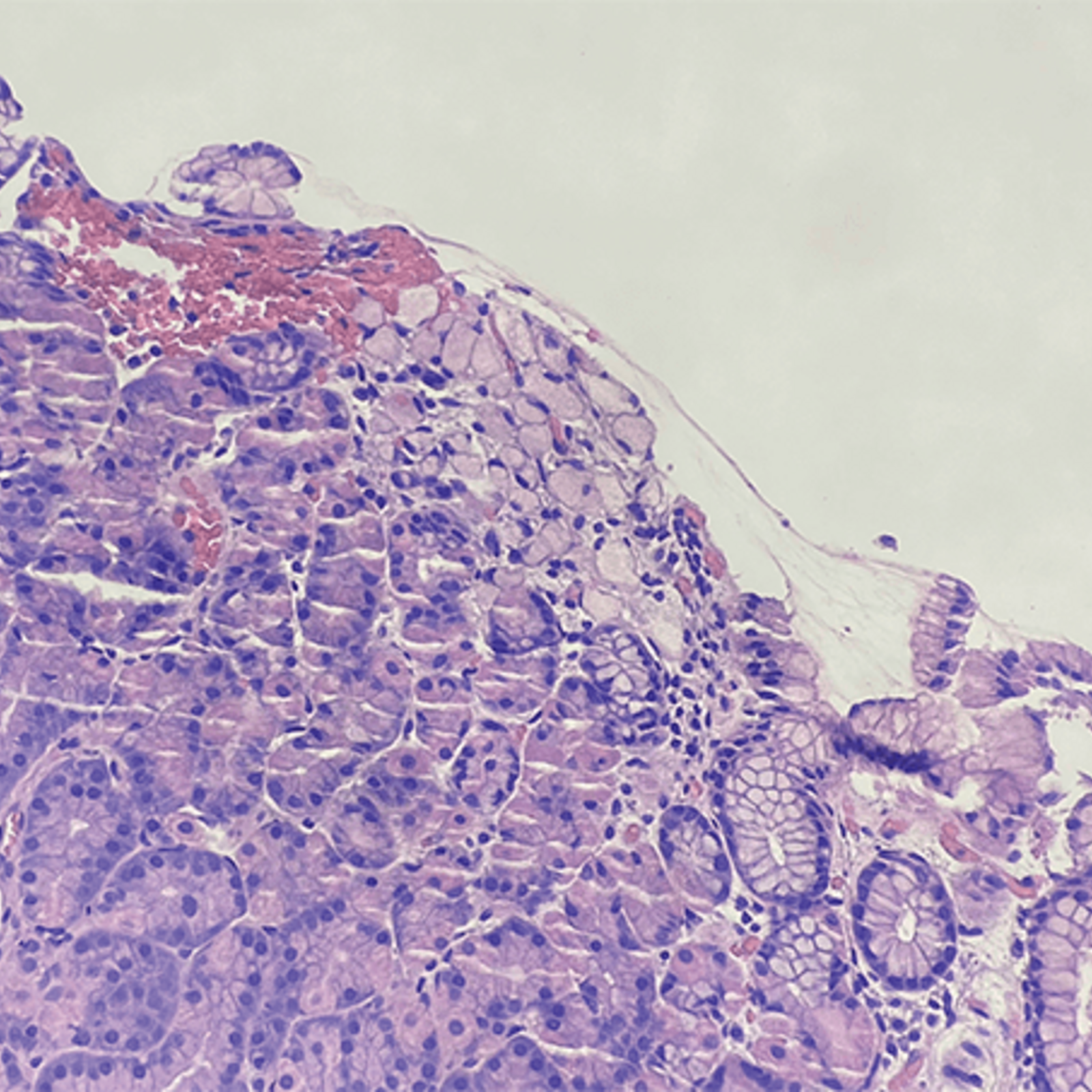 File:Signet ring cell carcinoma of the urinary bladder -- intermed mag.jpg  - Wikimedia Commons