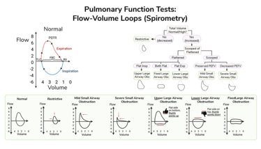 An infographic on the topic of pulmonary function tests that illustrates the different flow-volume loops seen in spirometry and links these with different disease processes (such as small and large airway obstructions at different locations in the respiratory tract).