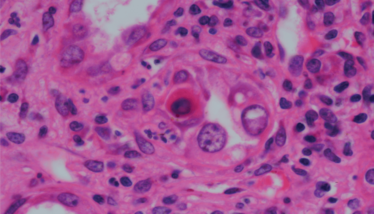A histologic image of a renal biopsy showing decoy cells.